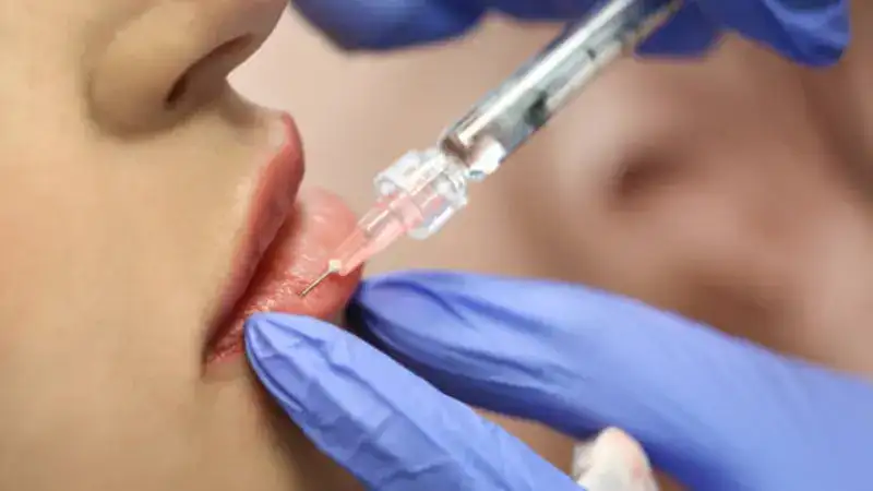 Lip Fillers