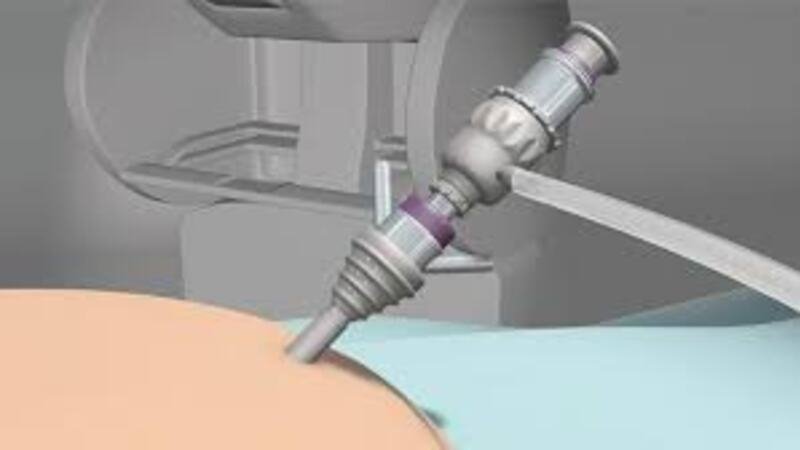 Gastric sleeve surgery Maryland