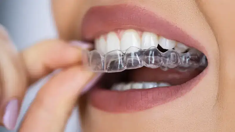 Crooked Teeth to Clear Teeth Aligners